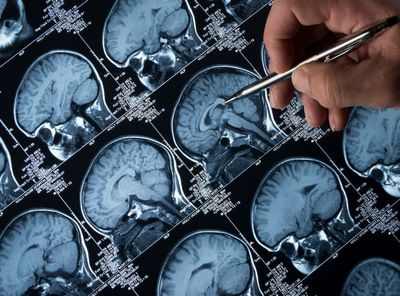 Новый маркер мозга обещает предсказывать болезнь Альцгеймера в будущем