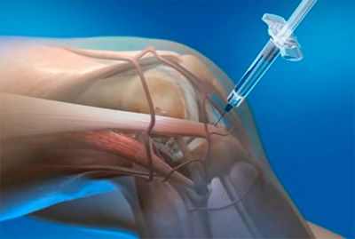 Уколы коленного сустава при артрите? Экономьте свои деньги, говорится в исследовании