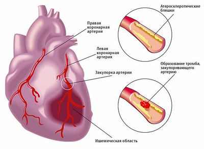 Прогресс для пациентов со слабым сердцем