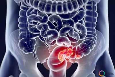 Использование аспирина связано с улучшением выживаемости после диагностики рака толстой кишки Использование аспирина связано с улучшением выживаемости после диагностики рака толстой кишки