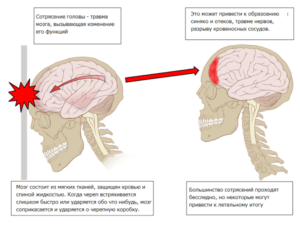 Недосыпание, стресс могут привести к появлению симптомов, напоминающих сотрясение мозга Недосыпание, стресс могут привести к появлению симптомов, напоминающих сотрясение мозга